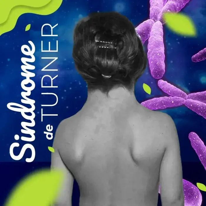 Niña que sufre de síndrome de Turner.