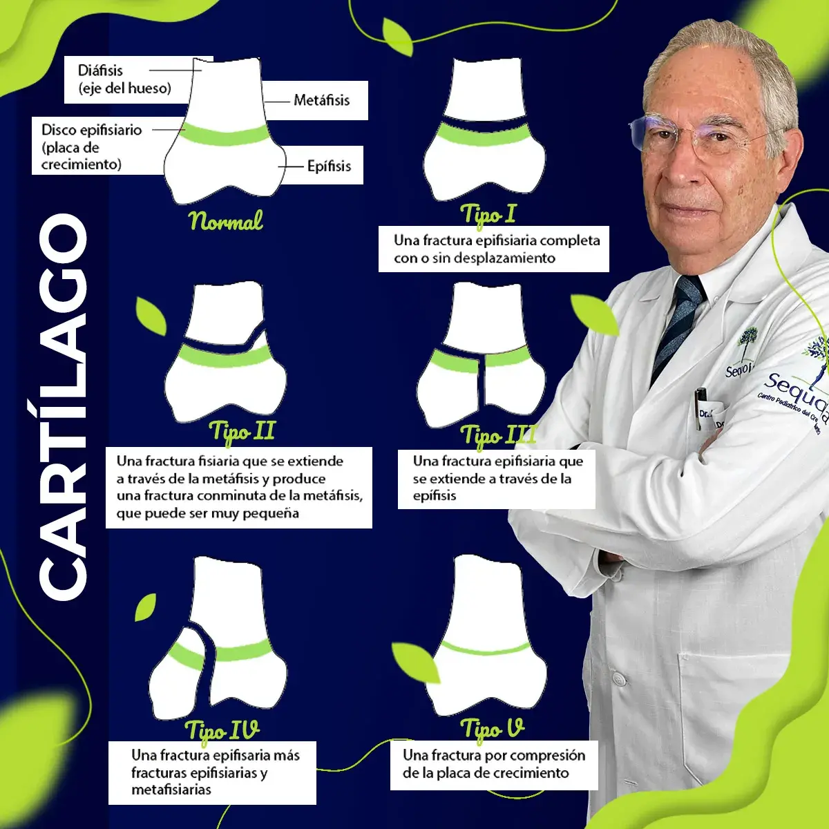Existen cinco tipos de fractura en los cartílagos de crecimiento.